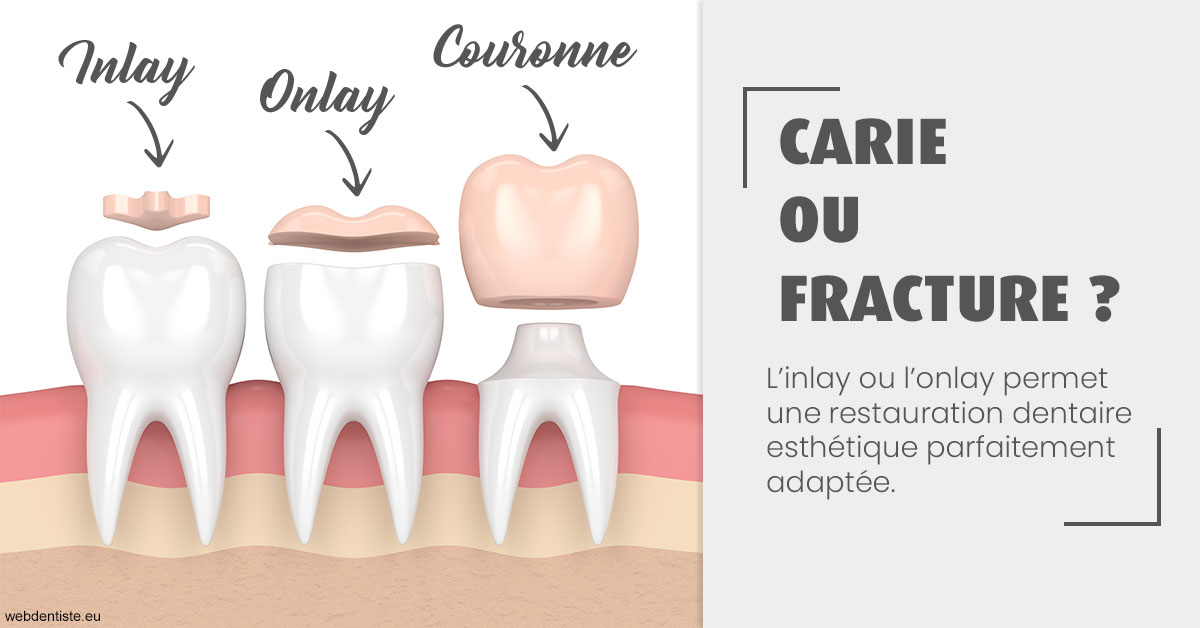 https://www.drbruneau.fr/T2 2023 - Carie ou fracture 1