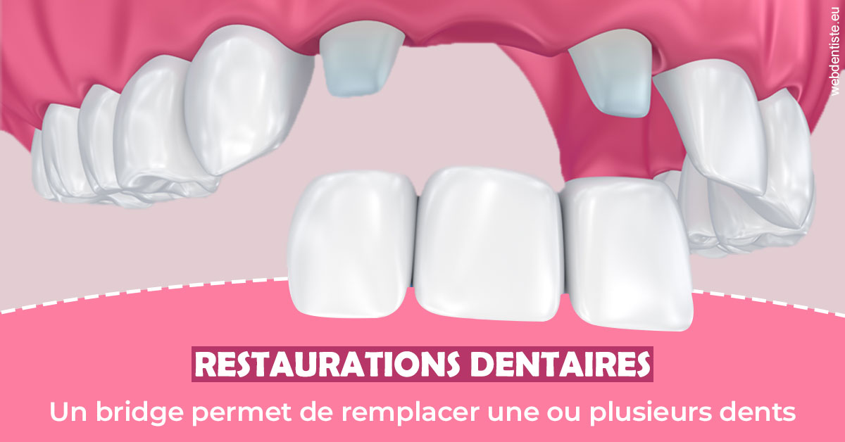 https://www.drbruneau.fr/Bridge remplacer dents 2