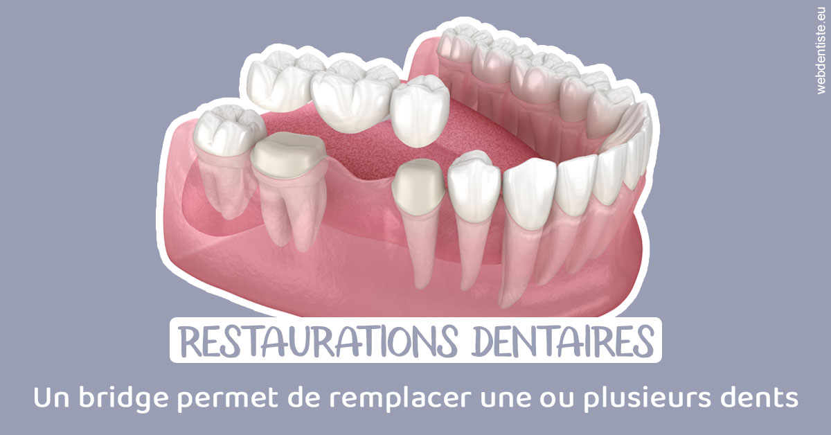 https://www.drbruneau.fr/Bridge remplacer dents 1