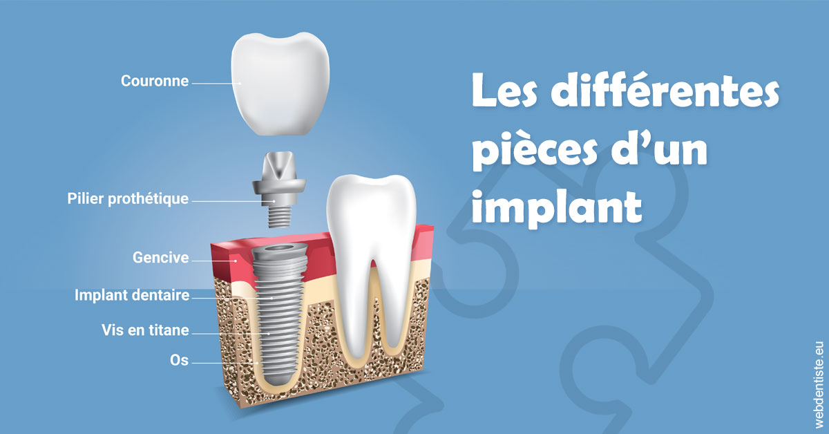 https://www.drbruneau.fr/Les différentes pièces d’un implant 1