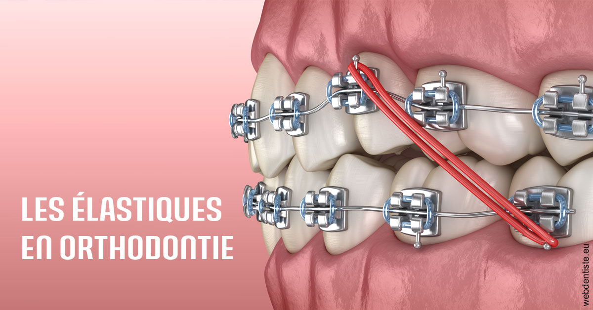 https://www.drbruneau.fr/Elastiques orthodontie 2