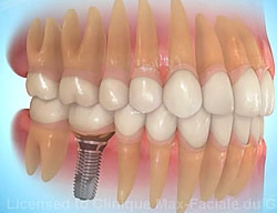 dental_implant_1